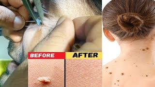 warts removal treatment and heading processموہکوں کا جڑھ سے خاتمہ [upl. by Wartow]