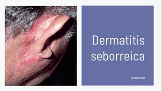 Dermatitis Seborreica  Actualización [upl. by Analahs]