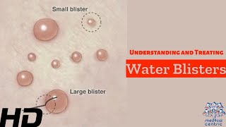 Water Blisters Unveiled Causes Treatment and Prevention [upl. by Sum749]