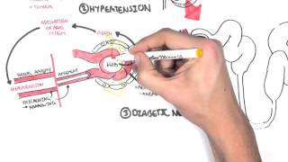 Chronic Kidney Disease CKD Pathophysiology [upl. by Scevo]