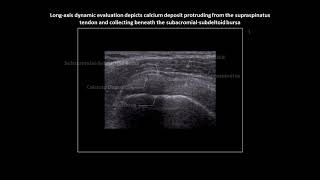 Supraspinatus calcific tendinopathy on shoulder ultrasound [upl. by Namref52]