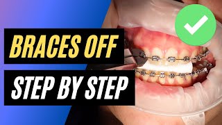 BRACES OFF  Step by step orthodontic removal [upl. by Male651]