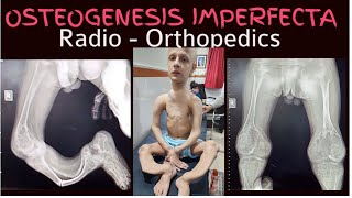 Osteogenesis Imperfecta CASE 1Video 2 RadioOrthopedic presentation Before Treatment [upl. by Cone542]