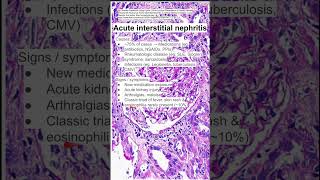 Acute interstitial nephritis [upl. by Aisaim]