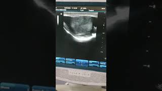 epididymal multiple cyst with mild hydrocele videos ultrasound viral video deos [upl. by Cargian365]