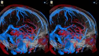 Arteriovenous Malformation AVM  3D Virtual Tour  UCLA Neurosurgery [upl. by Artenal]