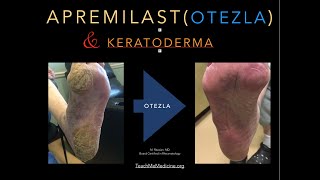 Apremilast Otezla and Keratoderma [upl. by Aninat266]