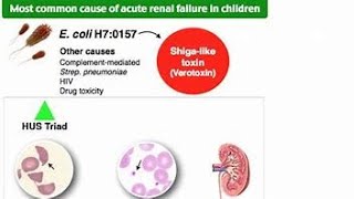 Hemolytic Uremic SyndromeHUS [upl. by Maryellen]