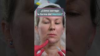 Corrección FACIAL impactante con Radiesse y Ácido Hialurónico [upl. by Rumit]