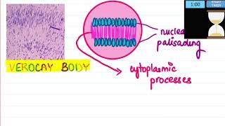 2 minute pathology SCHWANNOMA [upl. by Yenaiv823]