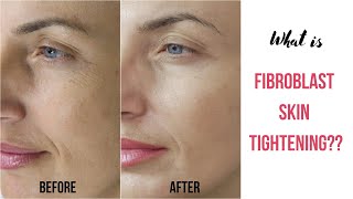 What is Fibroblast Skin Tightening [upl. by Durkee730]