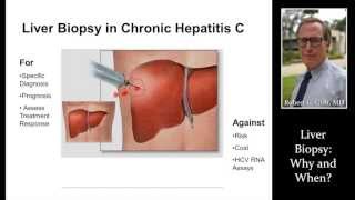 LIVER BIOPSY by Dr Robert Gish [upl. by Nahtnahoj]