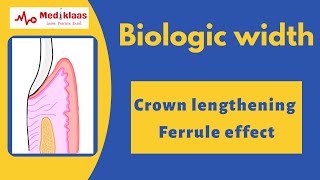 Biologic Width  A clinical review l Operative dentistry l Crown lengthening procedure l Mediklaas [upl. by Suoirad]