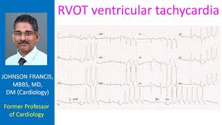 RVOT ventricular tachycardia [upl. by Nnaeitak765]