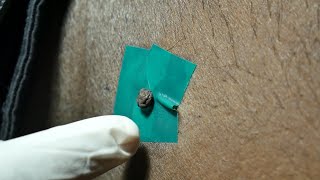 How to remove Warts Skin Tags and Moles naturally without Surgery  DrMSelvin Innocent Dhas [upl. by Hermon491]