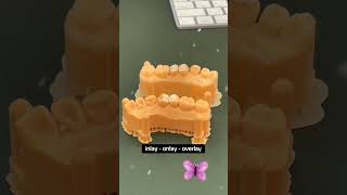 inlay  onlay  overlay dentist teethwhitening dentistry trending [upl. by Costanzia514]