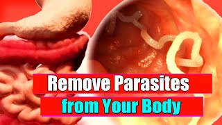 Remove Parasites from Your Body super fast Threadworms Treatment [upl. by Nahamas]