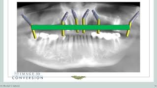 Season 1 Ep 3  Mastering Pterygoid implants and digital planning A comprehensive exploration [upl. by Ailama]