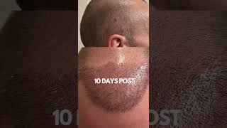 Hair Transplant Results Before amp After Timeline hairtransplantresults shorts [upl. by Kari]