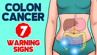 7 Warning Signs of Colon Cancer in 2024 [upl. by Aisul]