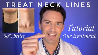 Injectors guide Treating Neck Lines Tutorial using dermal fillers [upl. by Hajan625]