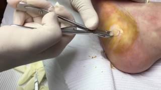 Wart removal surgery [upl. by Bramwell]