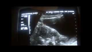 ultrasound learning FIBROID  part 1 of 2 [upl. by Ymirej]