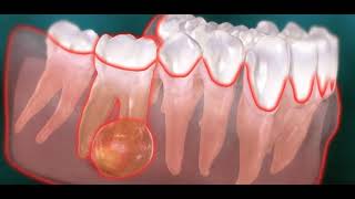 Abcès endodontique dentaire kyste [upl. by Britta]