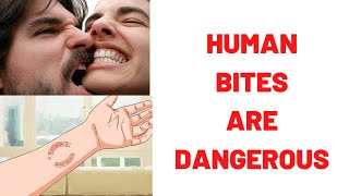 HUMAN BITES ARE DANGEROUS Human Bites What To Do  Human Bites Treatment Symptoms Complications [upl. by Brewer753]