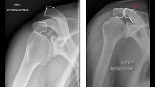 luxation clavicule chirurgie arthroscopique [upl. by Ithaman]