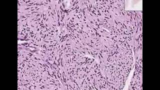 Histopathology SkinPalisaded Encapsulated Neuroma solitar [upl. by Netnerb]