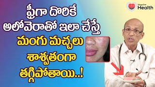 Mangu Machalu  ఫ్రీగా దొరికే అలోవెరాతో ఇలా చేస్తే మంగు మచ్చలు Dr Ch Madhusudana Sarma  ToneHealth [upl. by Ittak319]