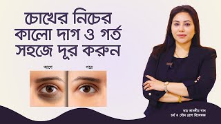 চোখের নিচে কালো দাগ ও গর্ত দূর করার উপায়। Ways to remove dark spots and holes under the eyes [upl. by Norvan]