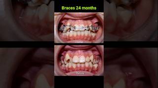 Braces correct all cases of crooked teeth braces orthodontist bracket [upl. by Lahpos397]