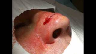 Surgery on the Nose for Squamous Cell Carcinoma [upl. by Eugen196]