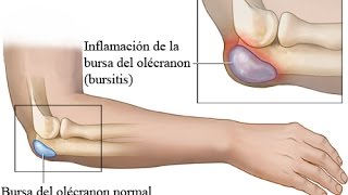 BURSITIS CODO DERRAME ARTICULAR TRATAMIENTO [upl. by Ariak]