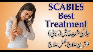 Scabies  Itching  Best Treatment in Homeopathy UrduHindi by Dr Safdar Iqbal [upl. by Aihcela945]