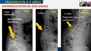 SPINE WEBINAR 22 ESPONDILOLISTESIS CLASIFICACION Y TRATAMIENTO ACTUAL [upl. by Rockie761]