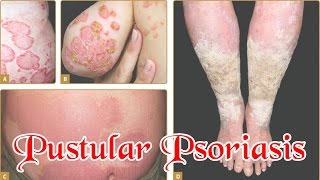 Pustular Psoriasis  How To Treat Pustular Psoriasis Naturally [upl. by Anoyek]