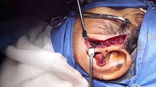 Fractura Mandibular Intracapsular [upl. by Ateerys]