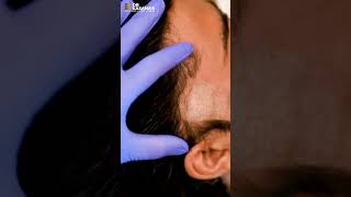 Birthmark Removal Laser Treatment  How to Remove Birthmark Easily  Dr Lalit Kasana [upl. by Ecerehs]