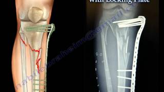 External Fixation With Locking Plate  Everything You Need To Know  Dr Nabil Ebraheim [upl. by Aridnere]