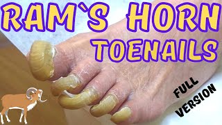 Super long toenails painless trimming Rams horn toenails [upl. by Aznecniv284]