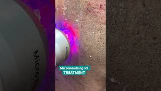 Microneedling RF TR  Post procedure skincare tips parisaskinclinic acnetreatmentinchandigarh [upl. by Eimot]