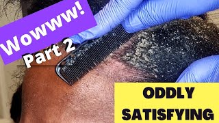 Oddly Satisfying Insane Dandruff Scratching Flakes Scalp Condition Removal After Braids Pt 2 [upl. by Ahsikel]