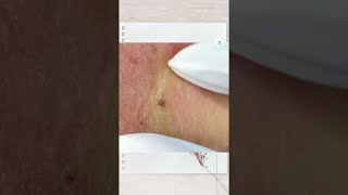 Big Cystic Acne Blackheads Extraction Blackheads amp Milia Whiteheads Removal Pimple Popping shorts [upl. by Marte]