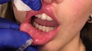 Dissolving Lip Filler by Dr Kassir [upl. by Restivo]