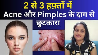 PIMPLES दाग को बोलो Goodbye  Its time to get CLEAR amp SPOTLESS SKIN [upl. by Alletsyrc]