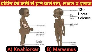 प्रोटीन की कमी से होने वाले रोग लक्षण व इलाज  Kwashiorkor disease  Marasmus disease [upl. by Enahsal204]