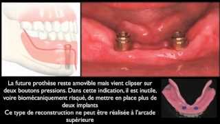 Prothèse amovible et implants dentairesMandibular overdentures [upl. by Nelleeus]